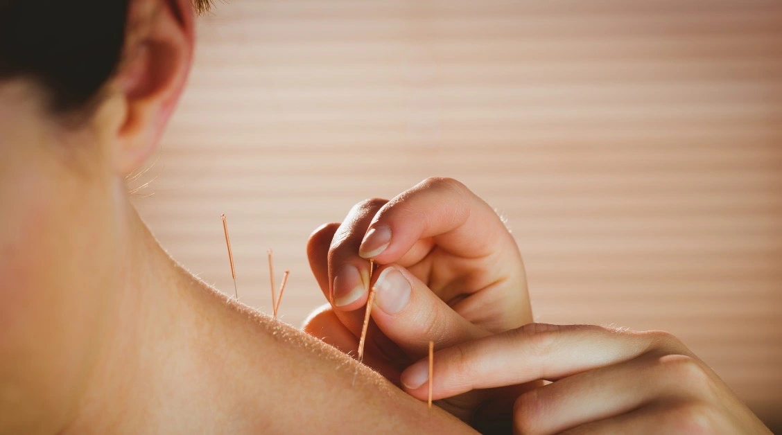 آکوپانکچر یا طب سوزنی