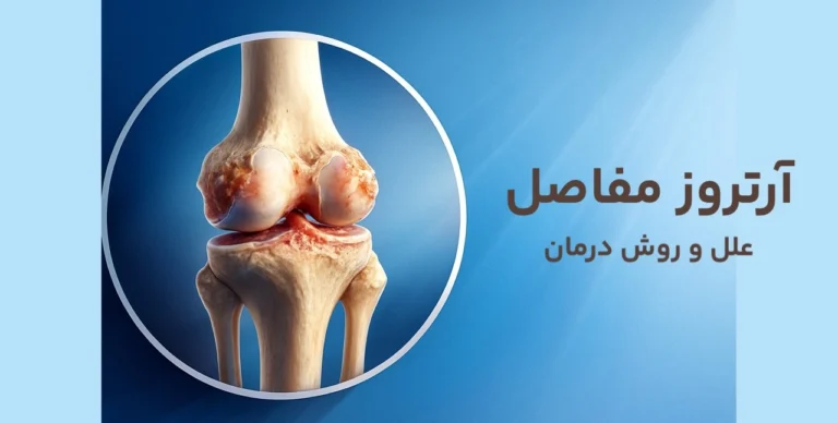 آرتروز مفاصل