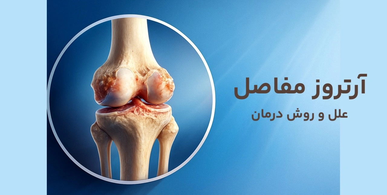 آرتروز مفاصل